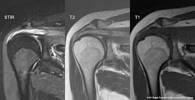 SUPRASPINATOUS%2BGANGLION%2BCYST.jpg